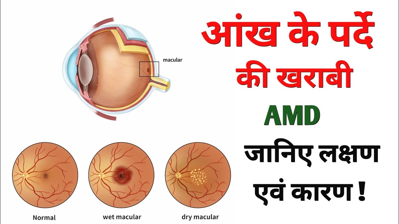 Macular Degeneration क्या होता है?|जानिए लक्षण एवं कारण| AMD|Age Related Macular Degeneration|