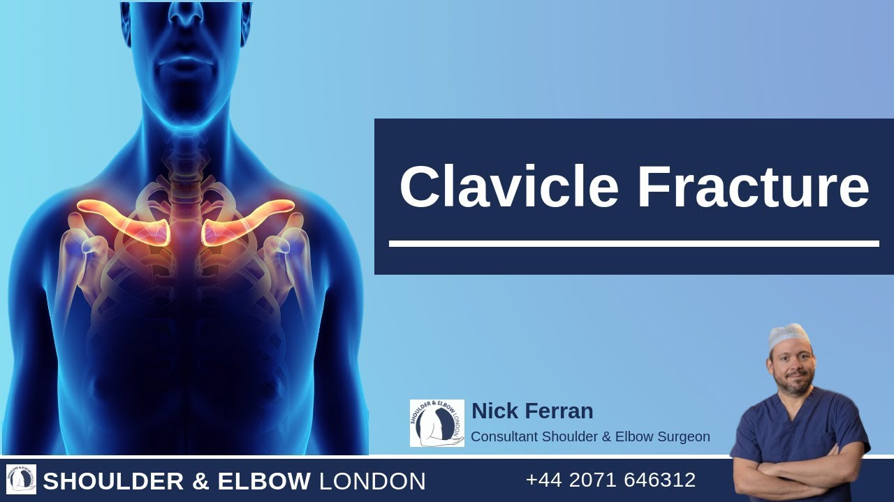 Clavicle Fracture
