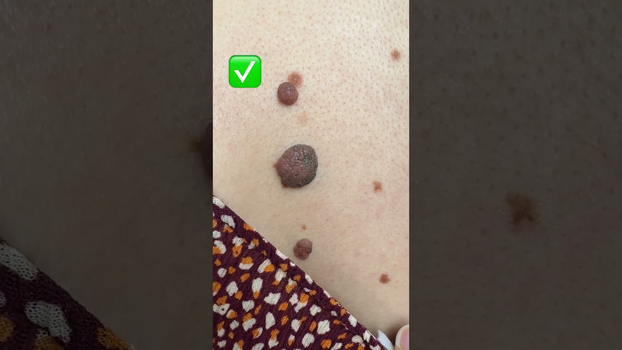 🔎 &iquest;Tienes lunares?&iexcl;OJO A ESTO! @atida_mifarma