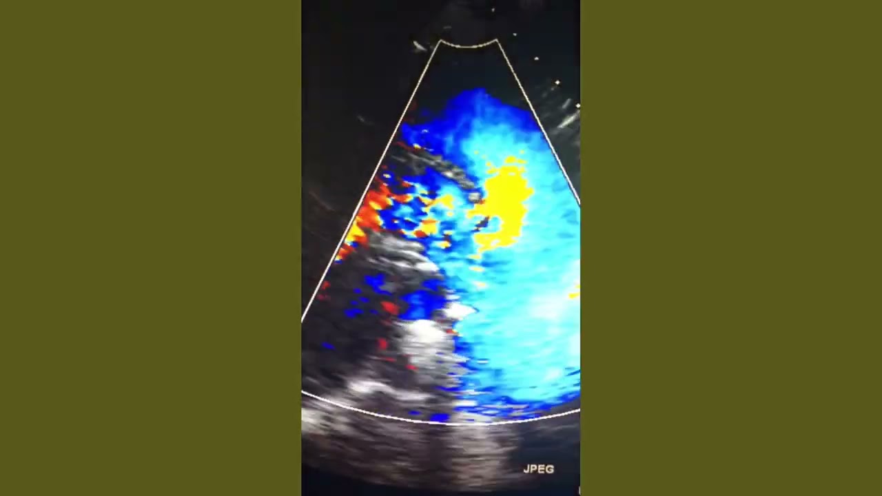 Patent Ductus Arteriosus (PDA)