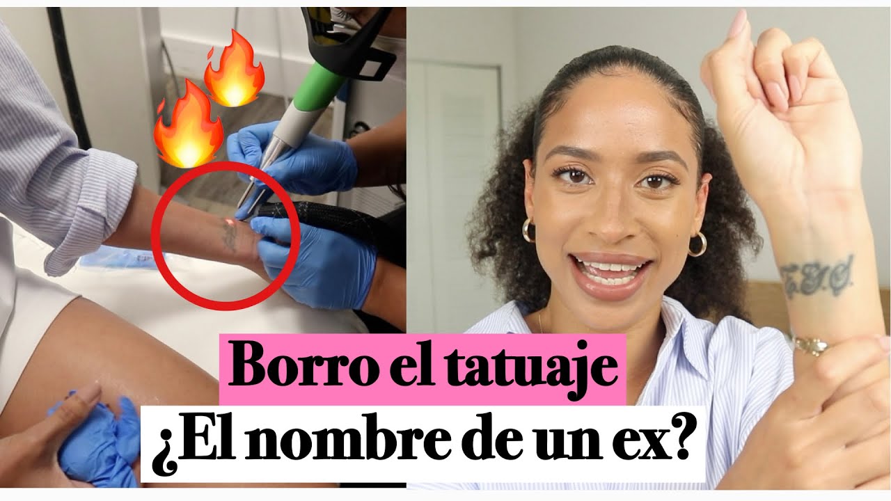 Me borro el tatuaje con láser :: Mi experiencia en la primera sesión | FRIZZYDESI