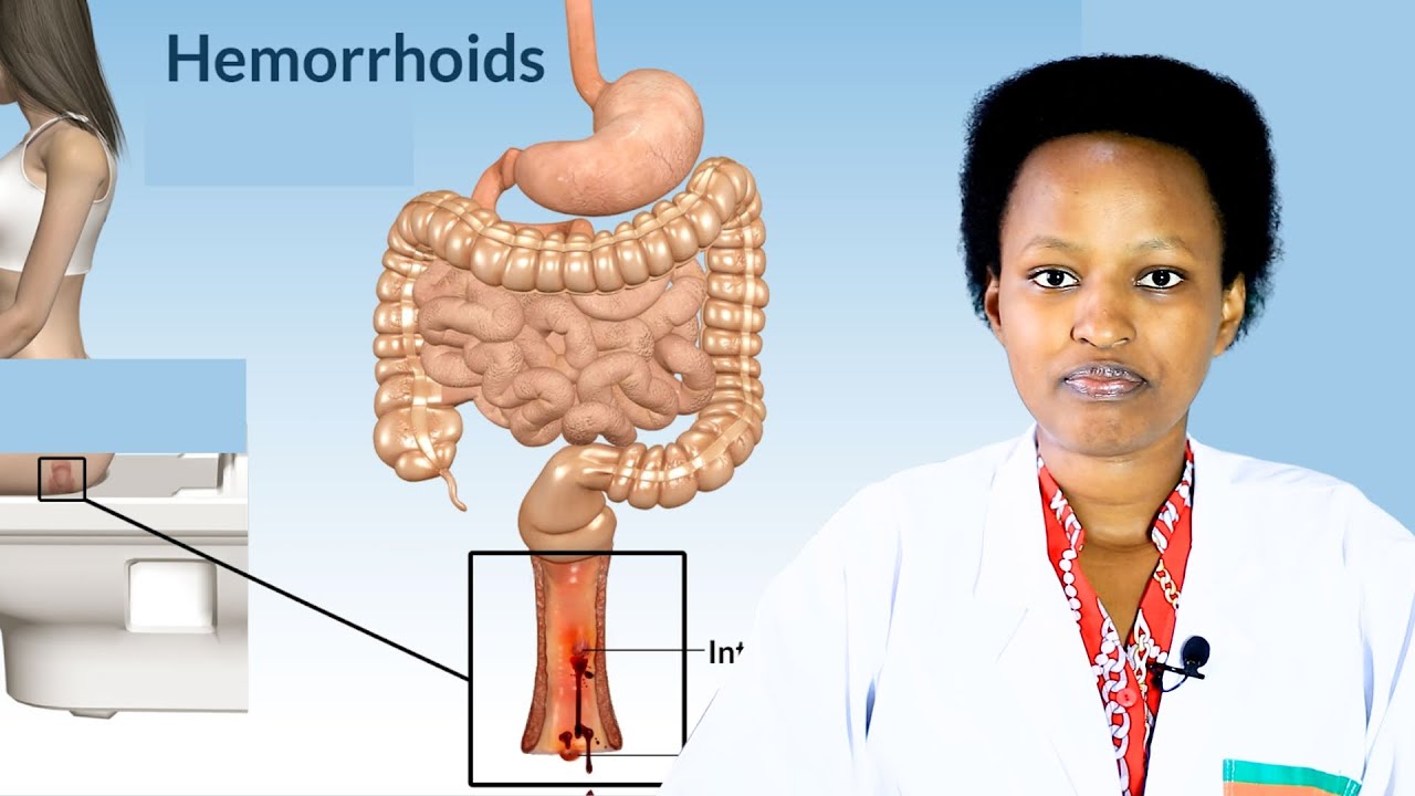hemorrhoids: Ibyo KWIRINDA KURYA nibyo ukwiriye KURYA! Nutritionist Leah
