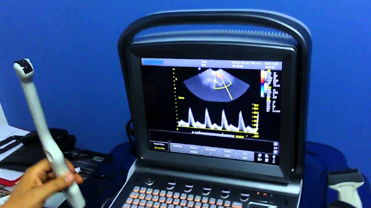ECOGRAFO PORTATIL CHISON COLOR DOPPLER Y DOPPLER PULSADO