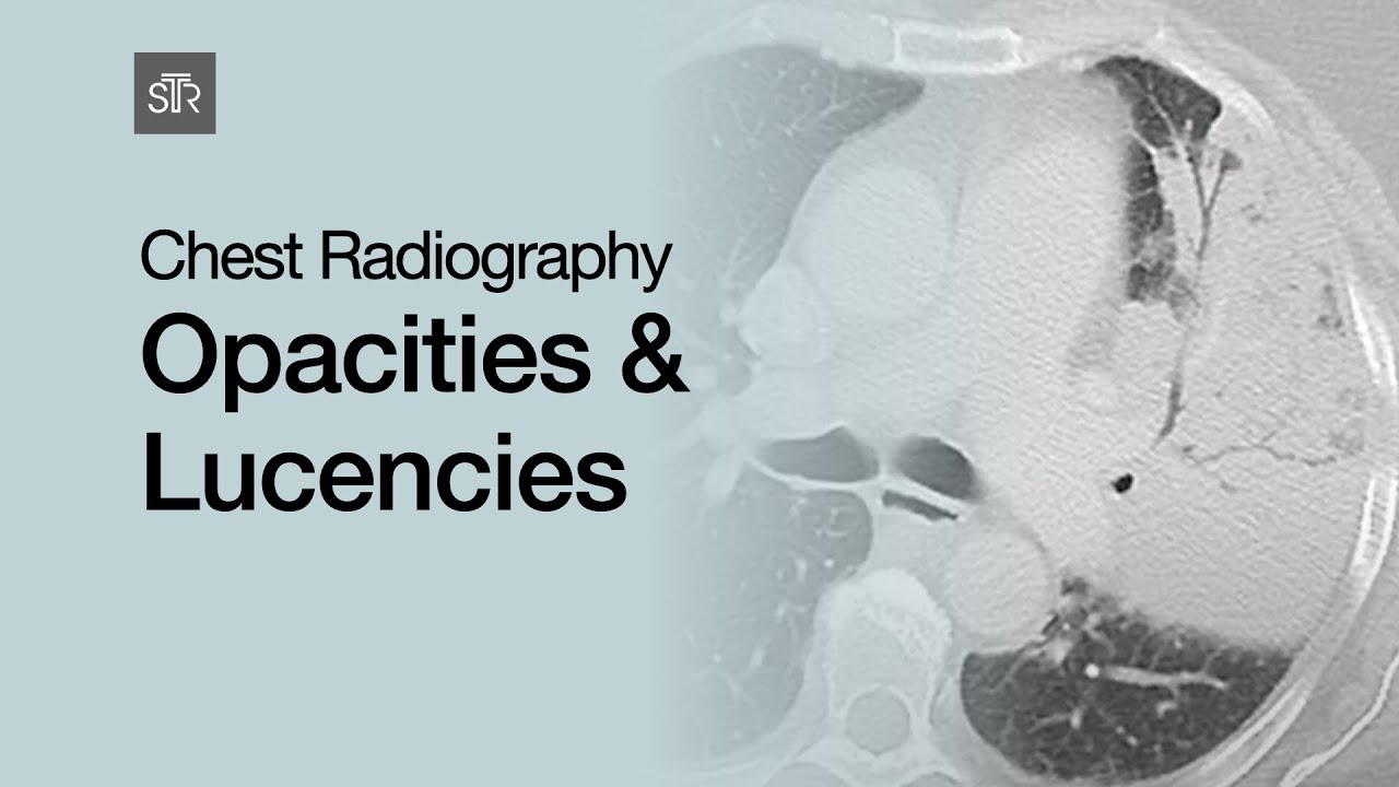 Chest Radiography: Opacities & Lucencies