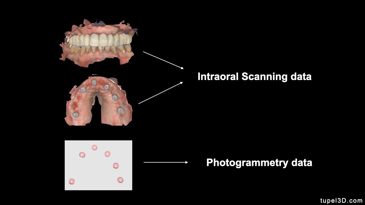 Digital Workflow in Complete-Arch Implant Restorations with Tupel3D Dental Photogrammetry System