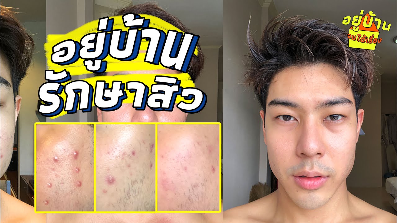 ผิวดีขึ้น!! รักษาสิวด้วย BENZAC ใช้ยังไงให้หาย  | FFLOG