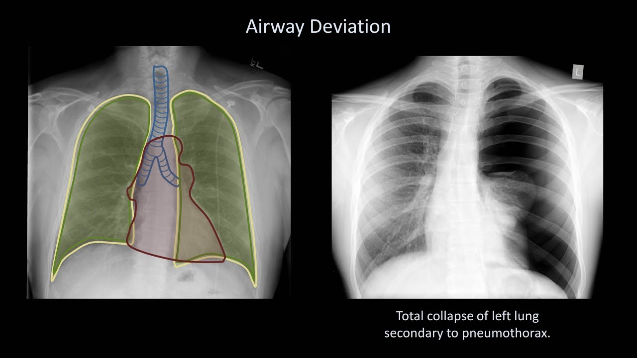 How to Interpret a Chest X-Ray (Lesson 4 - Airways, Bones, and Soft Tissues)