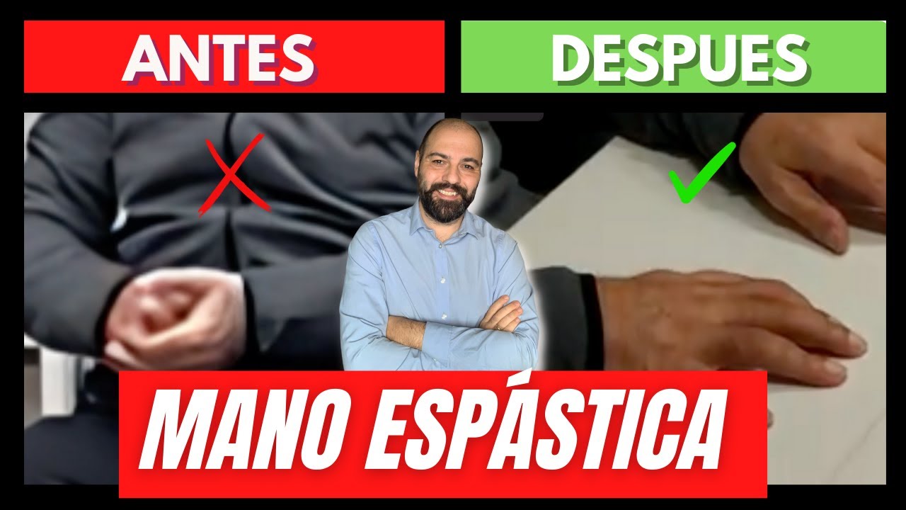 Ejercicios rehabilitación para la Mano espástica después de un ACV