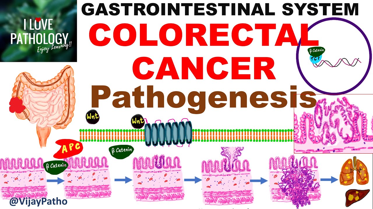Colorectal carcinoma - Epidemiology, risk factors & Pathogenesis