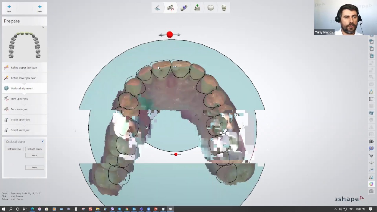 3Shape Digital Wax-up Mock Up Technique