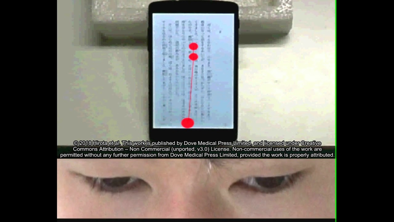 Smartphone reading in intermittent exotropia- SUB ID 177899
