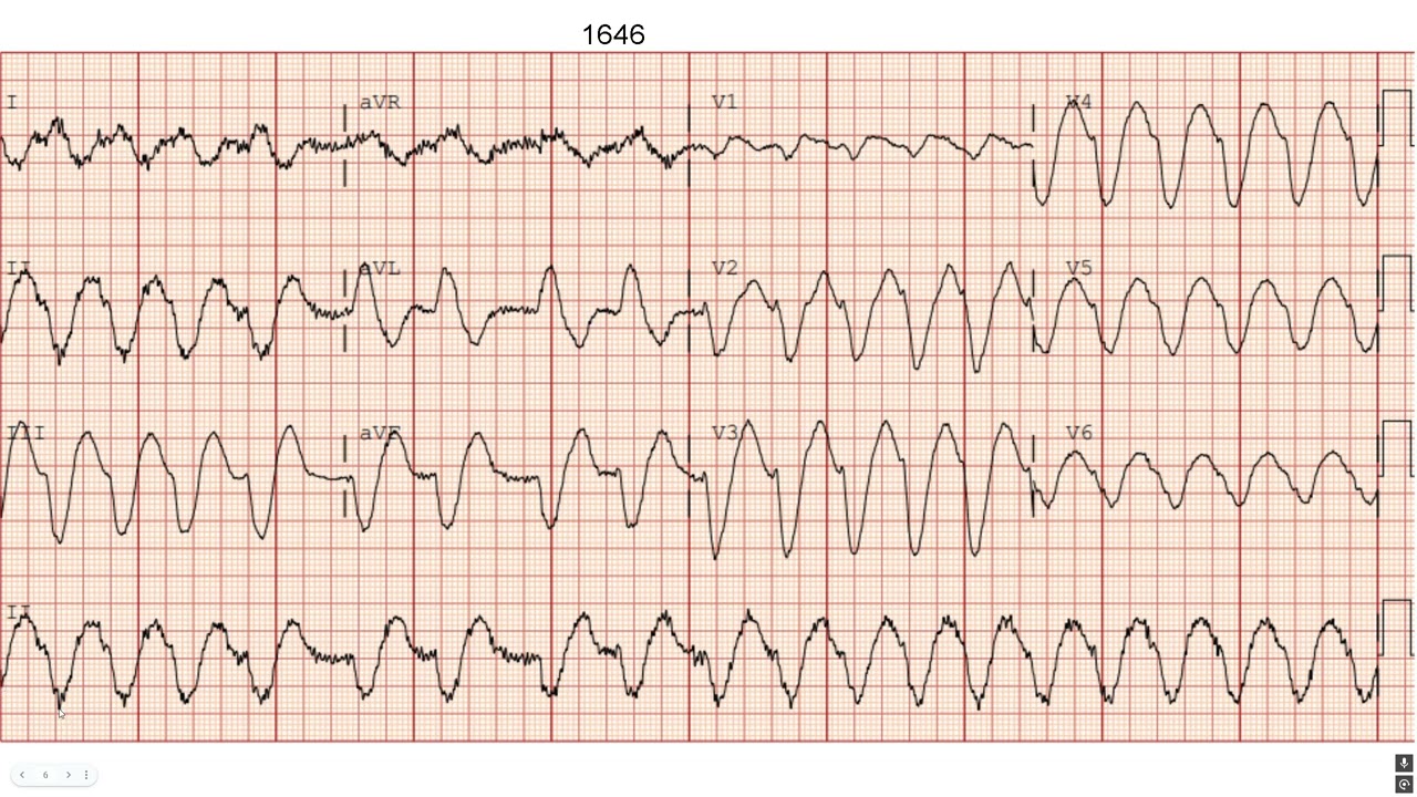 70 male SOB A Fib