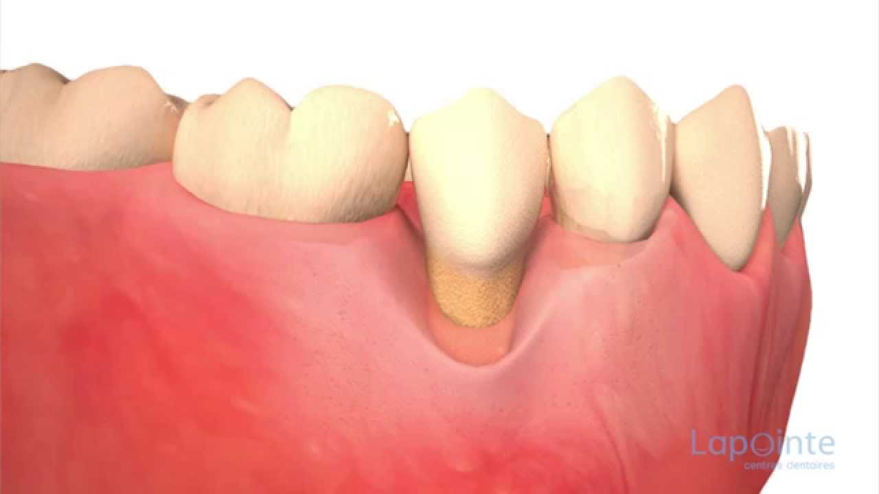 Greffe Alloderm® - Centres dentaires Lapointe
