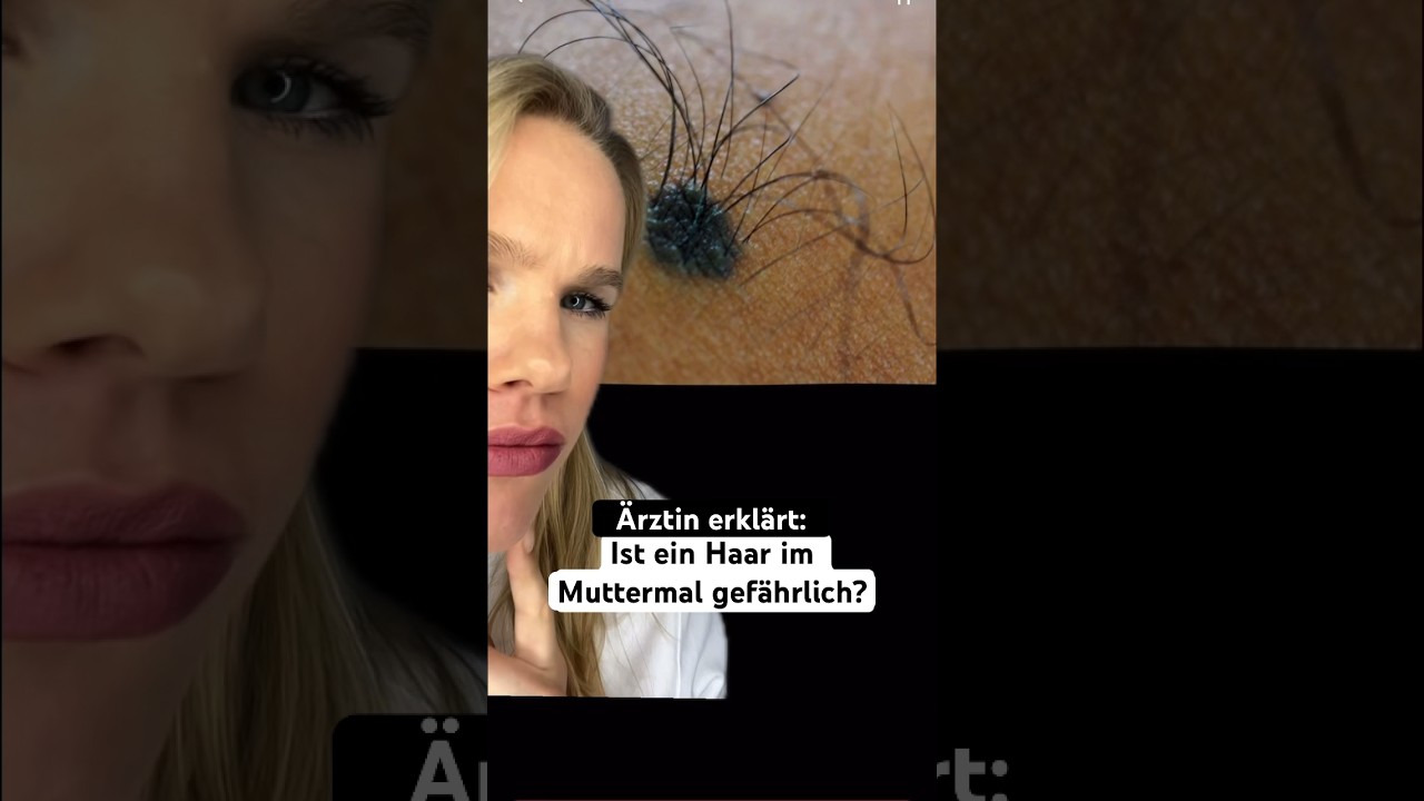 &Auml;rztin erkl&auml;rt: Haar im Muttermal #muttermal #hautkrebs #haar #abcderegel