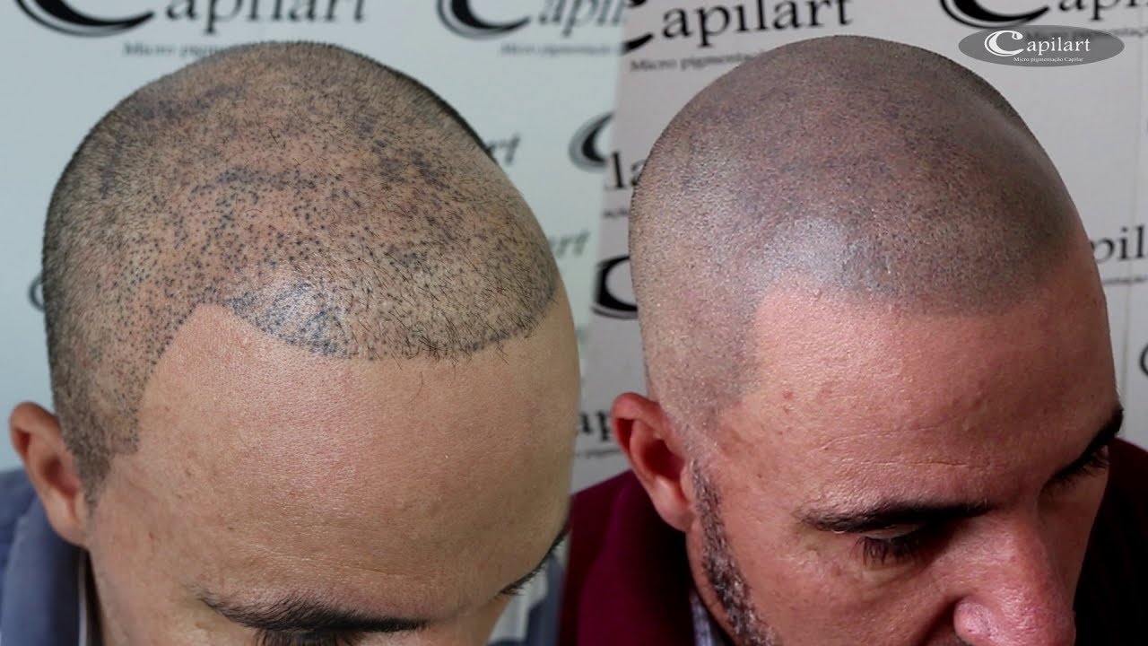 CONSERTANDO MICRO MAL FEITA Micropigmentação capilar | Capilart