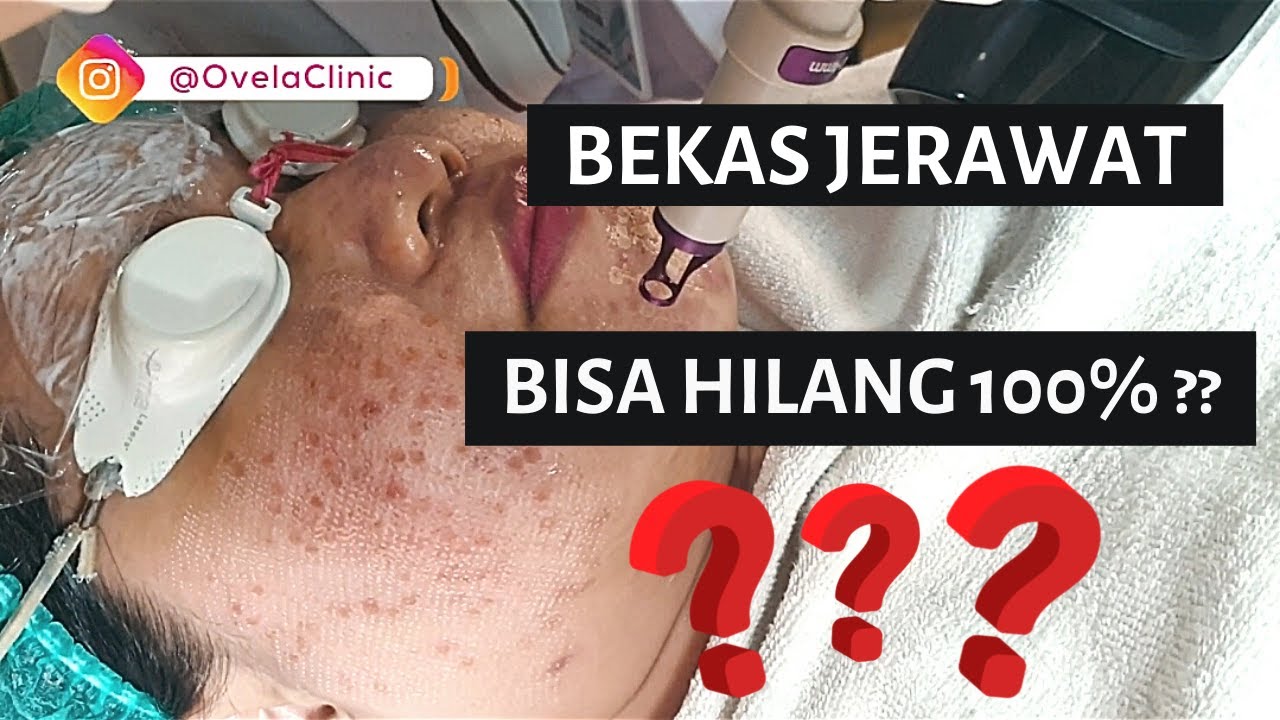 Cara Hilangkan Bekas Jerawat [+ Review Medis Hasil LASER SCAR] - Ovela Clinic - Jakarta