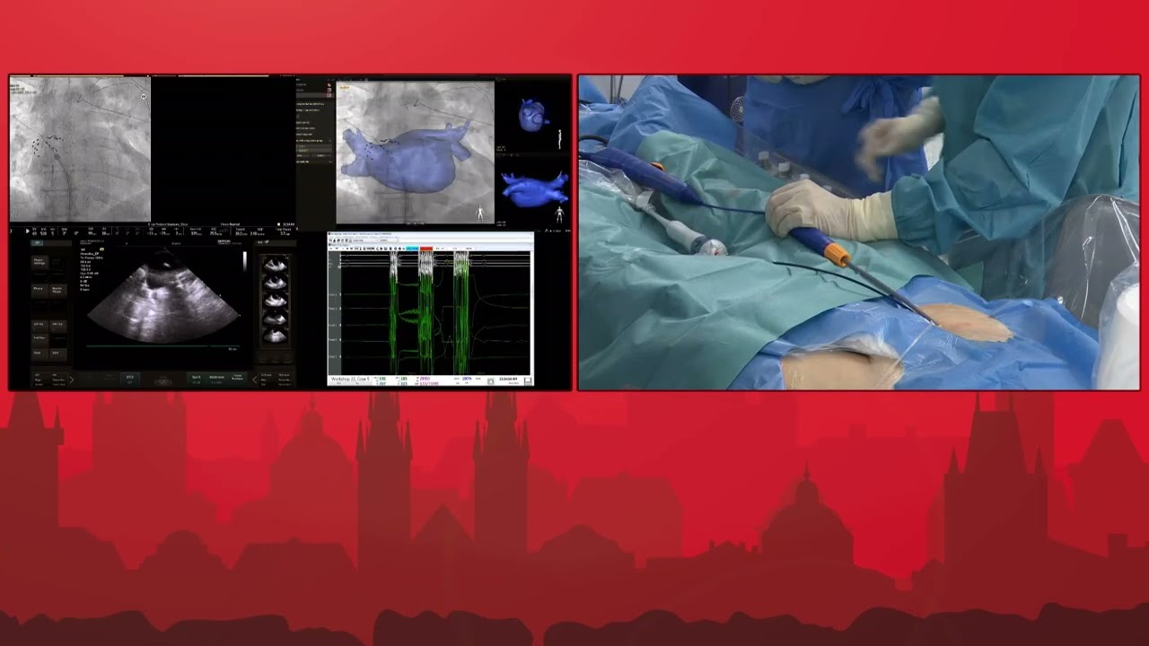 PR 2022, APRIL 25, Live demonstrations II – AF ablation - Part B