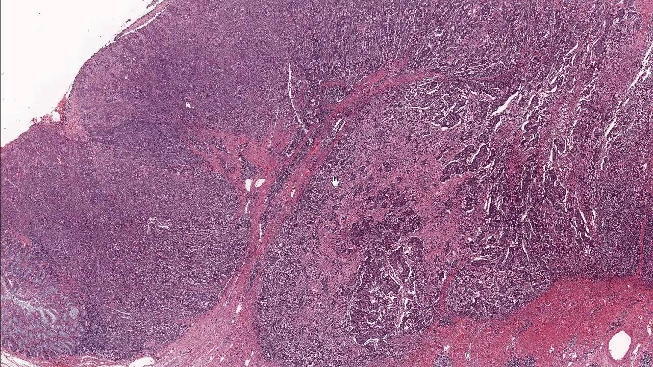 Colon Adenocarcinoma / Microscopic Diagnosis and Molecular Testing