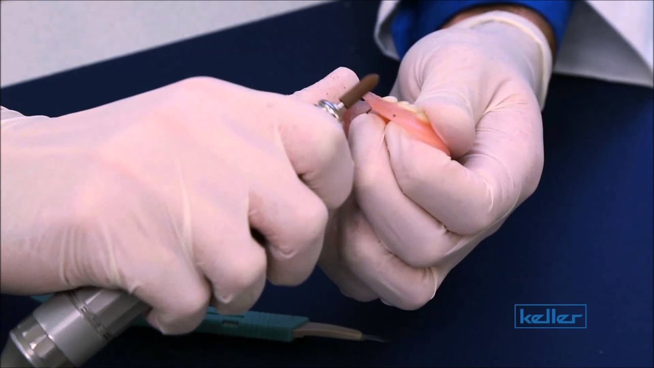 Keller Valplast Adjustment Video