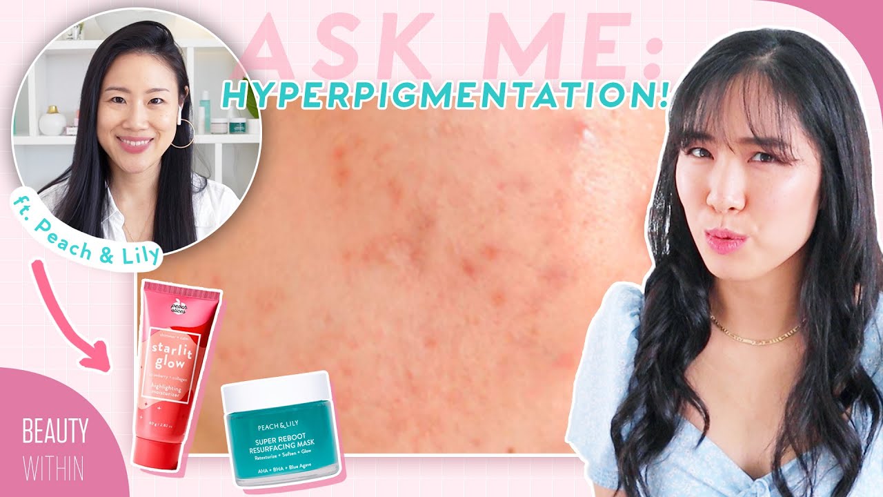 How to Reduce Acne Marks & Hyperpigmentation ft. @Peach & Lily