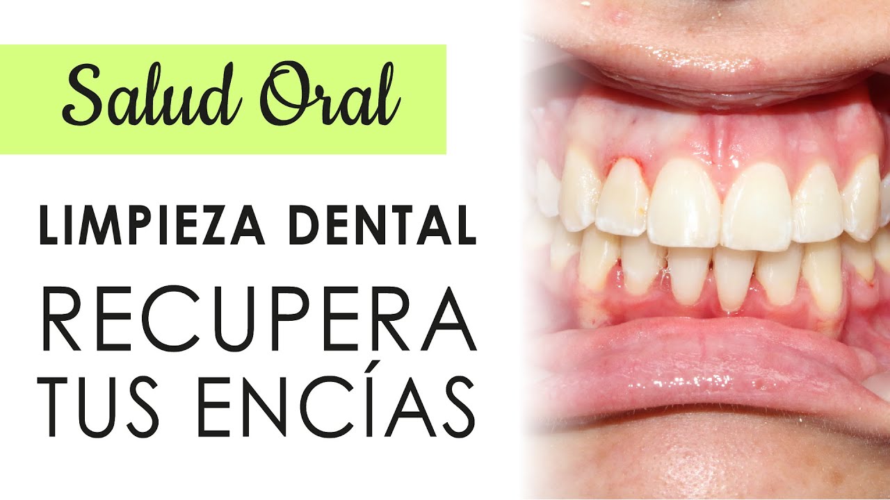 CUIDADOS DE LAS ENCÍAS DESPUÉS DE UNA LIMPIEZA DENTAL