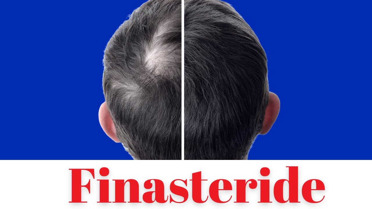 EVERYTHING to know about Finasteride (Propecia)