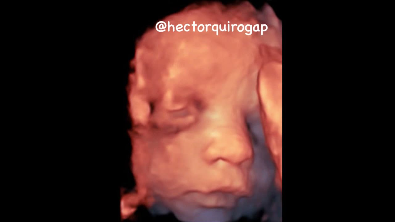 4D Ultrasound Scan of a Baby Girl at 31 Weeks. Gender at the end of the video.