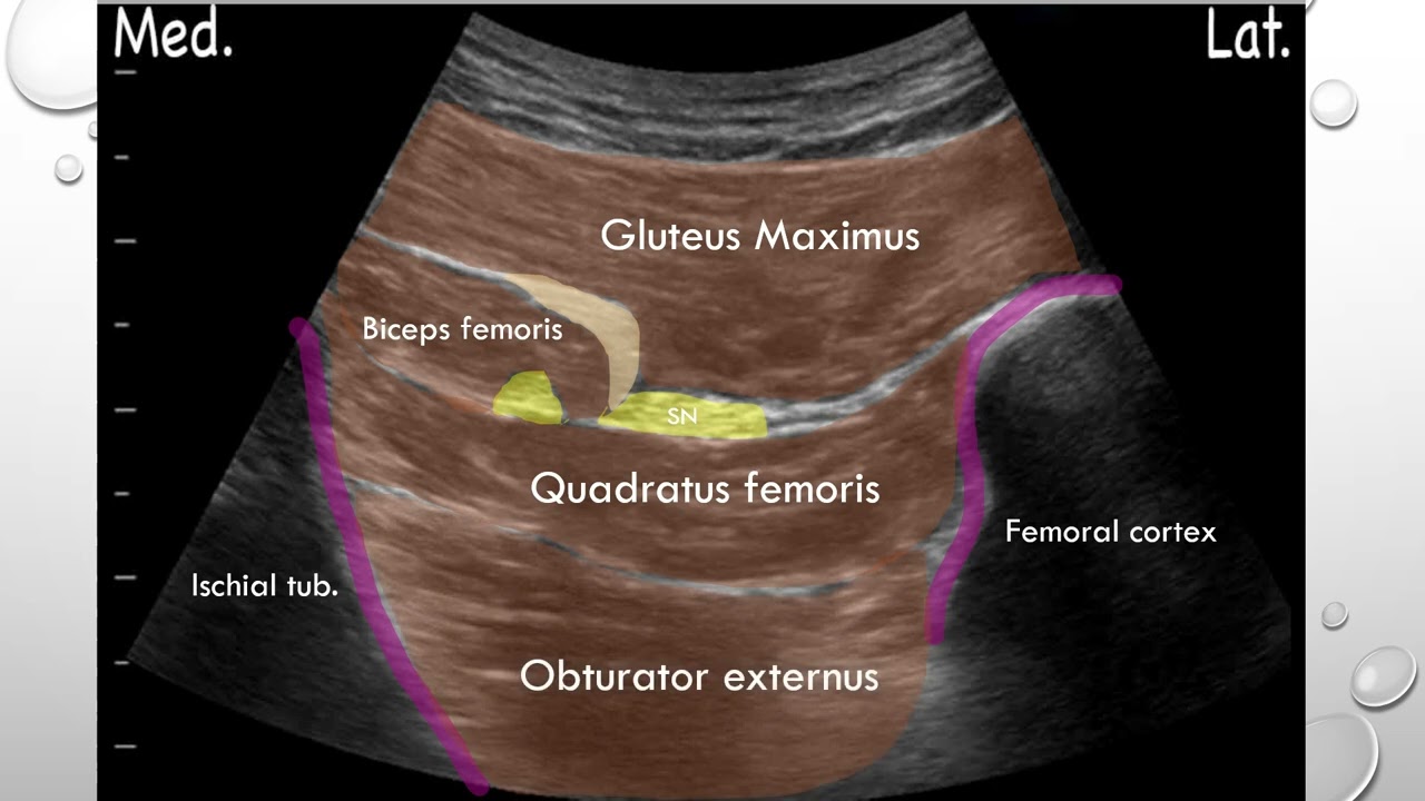 Approaches to Sciatic block