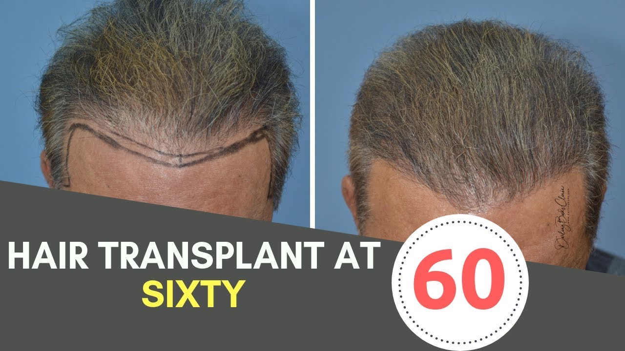 Hair Transplant at 60 Years Age and in the Elderly & Old