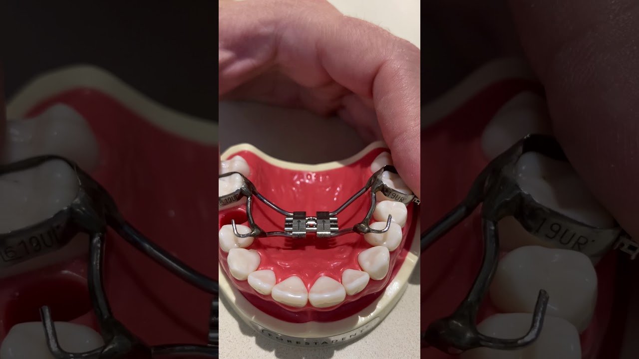 TUTORIAL - How to complete an incomplete Expander Turn