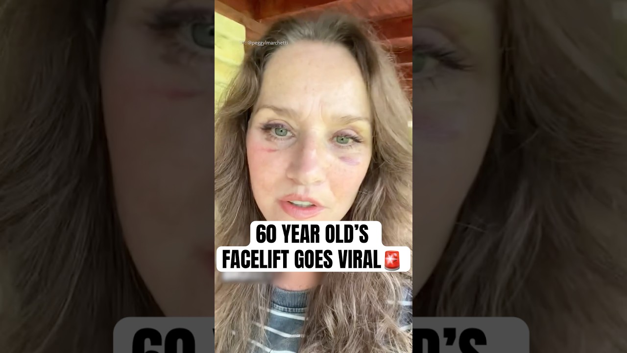TikToker Goes Viral For &ldquo;Mexican Face Lift