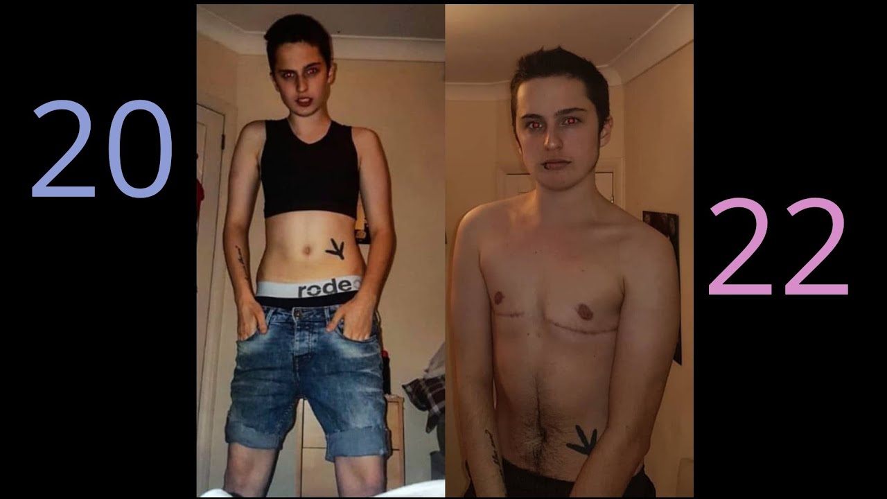 FTM Transition Timeline! 1 Year on Testosterone (2019)