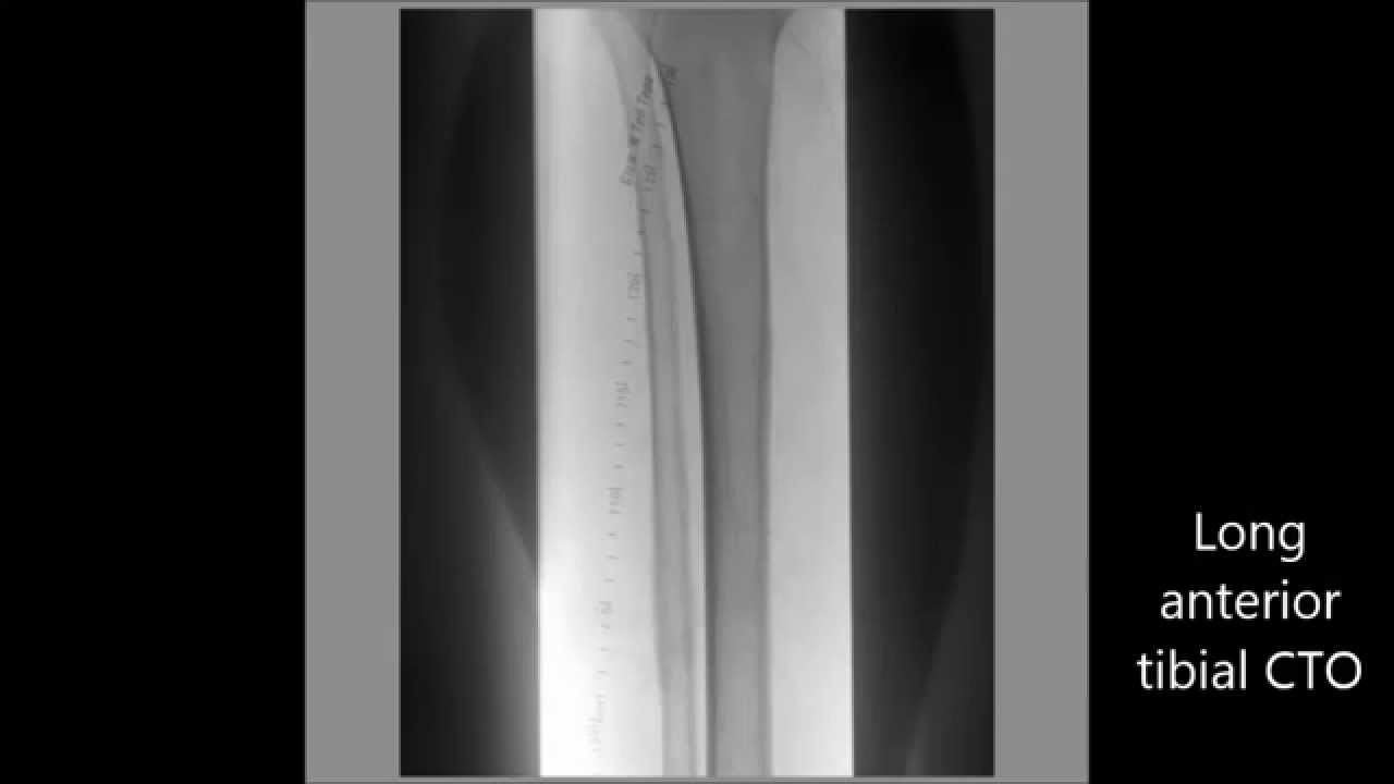 Retrograde pedal access after failed antegrade