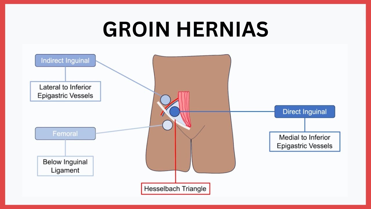 Groin Hernias Explained