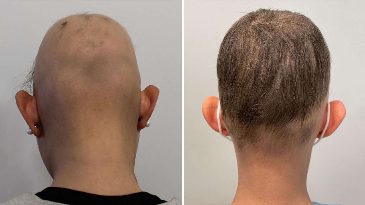 La Cura Para La Alopecia Areata: Baricitinib