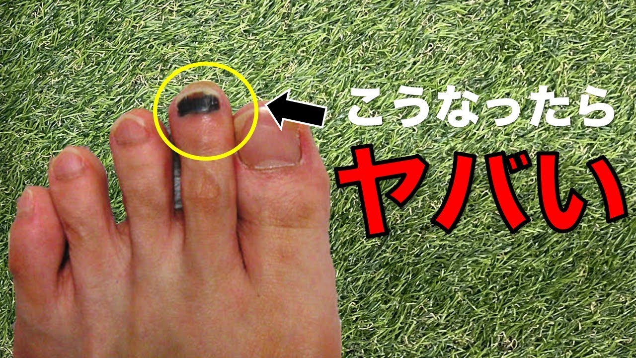 【知らないとヤバい】爪が黒くなる走り方と改善方法