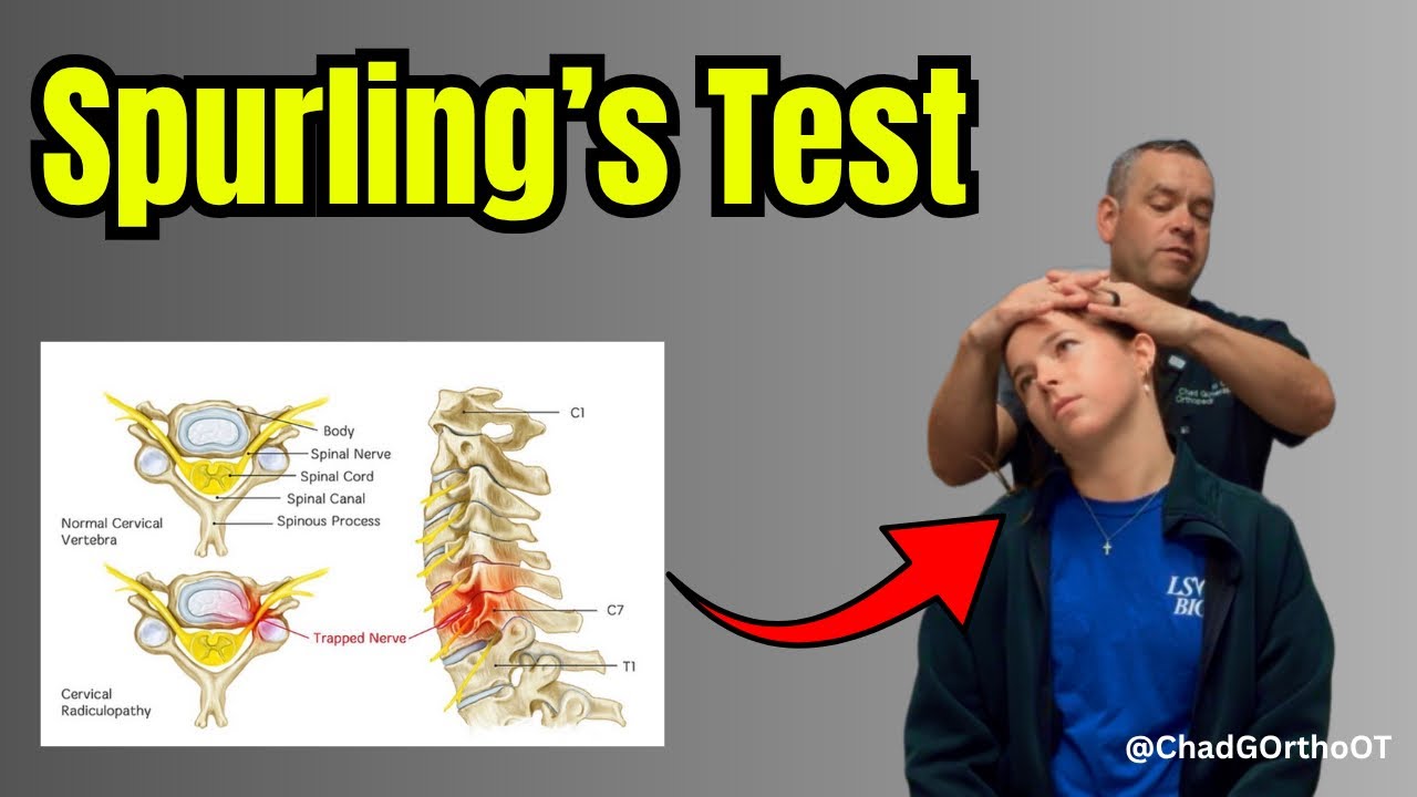 Тест Спурлинга: объяснение | Тест на шейную радикулопатию (компрессия шейного нерва)