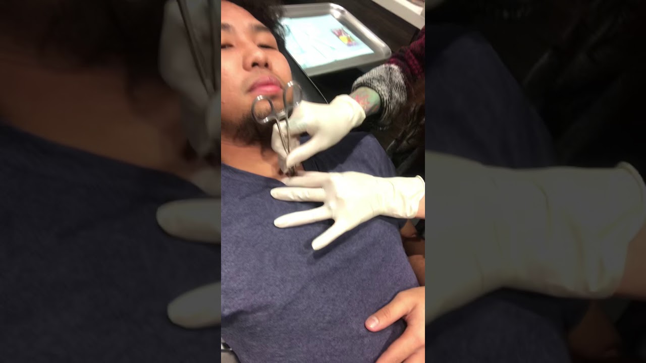 Removing my Dermal Piercing!