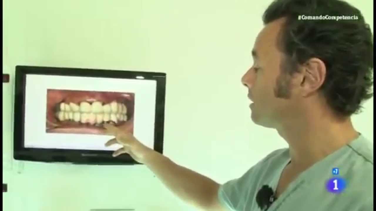 Reportaje - Precio y calidad de implantes dentales - Comando actualidad