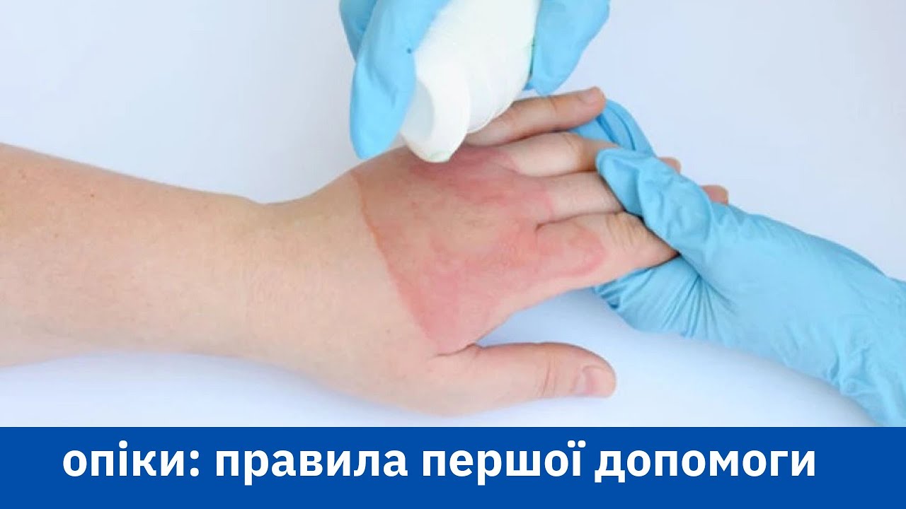 Перша допомога при опіках