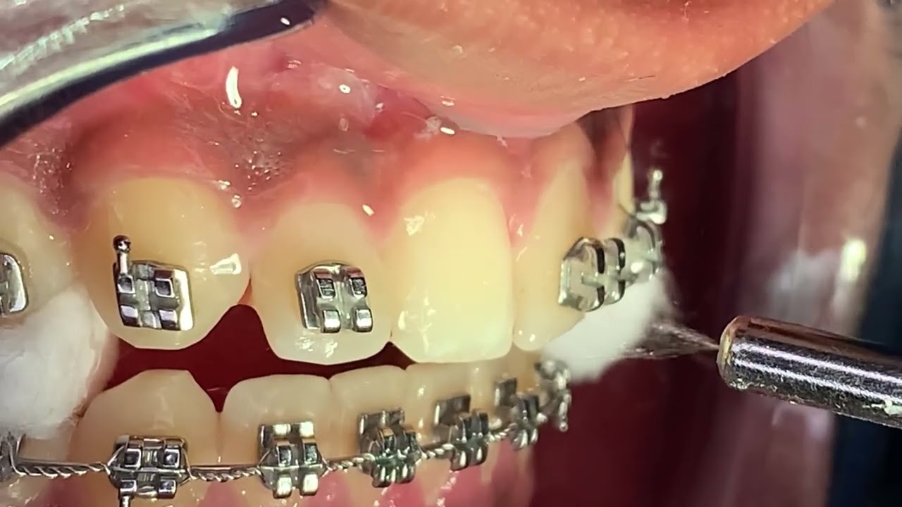 🔥Proceso Completo Para Instalar Frenillos Metálicos🔥