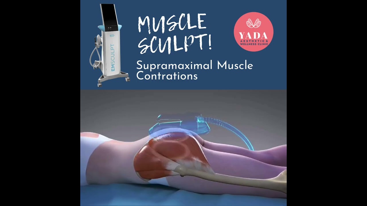 Muscle Sculpt by Emsculpt (How’s it work?) @ Yada Clinic Pattaya, Thailand.