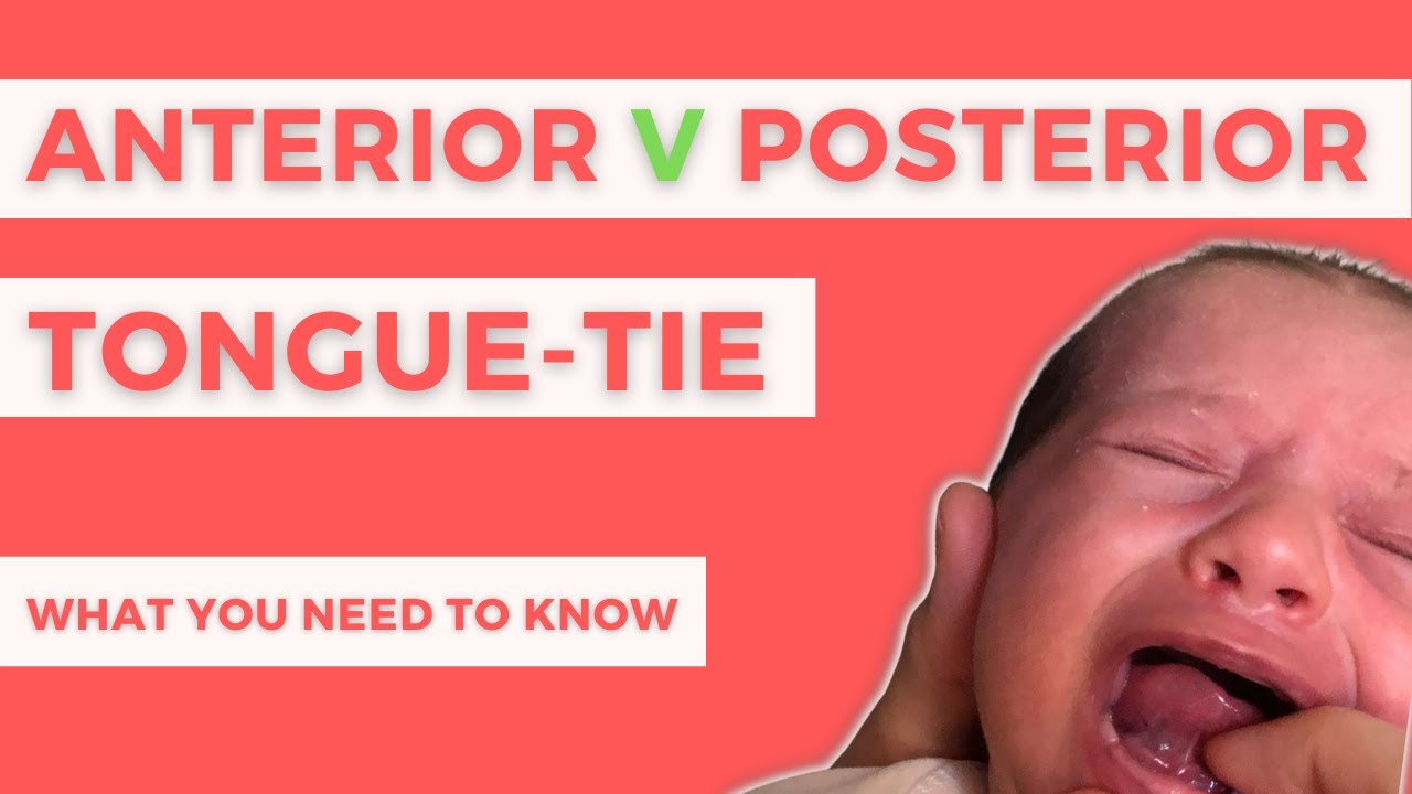Warning! Are you making this mistake when considering a tongue-tie division?