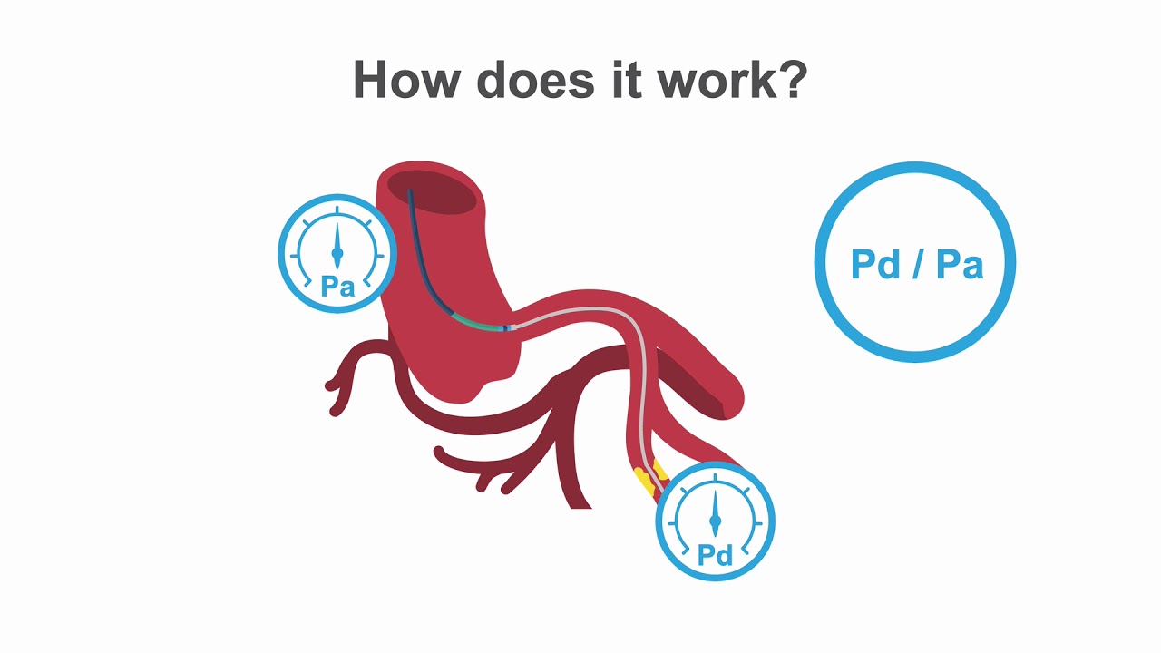 Utilizing Pressure Wire in PCI: Insights & Techniques