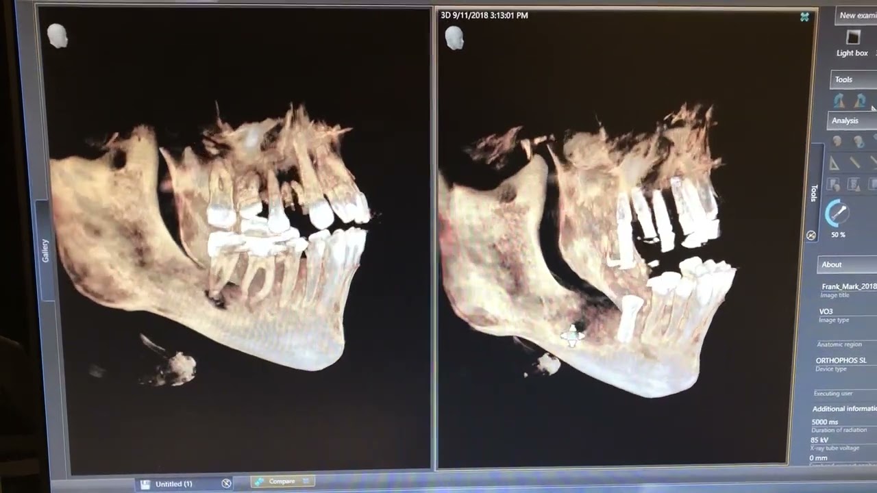 Before and After Upper and Lower Implant 2D Image