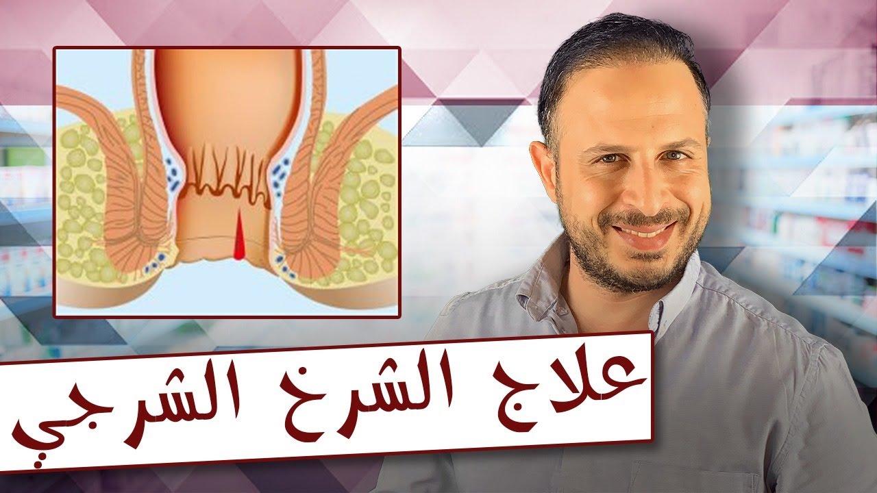 علاج الشرخ الشرجي بوصفة سهلة وسريعة