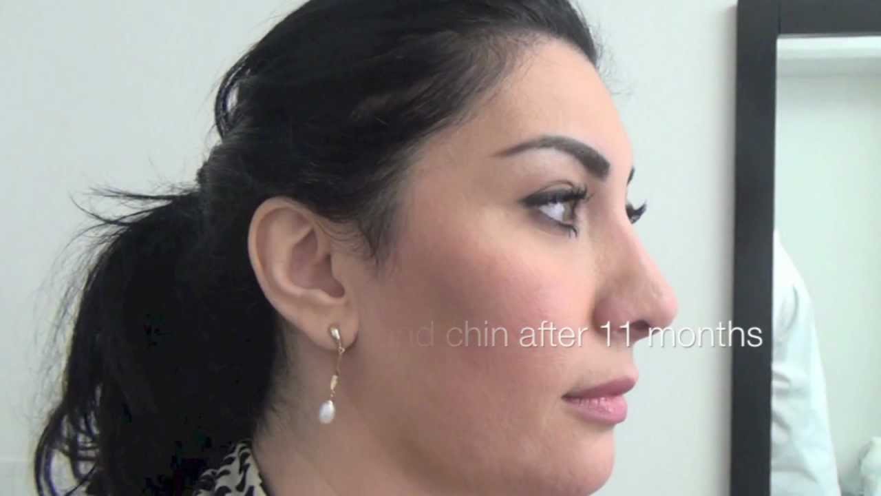 Rhinoplasty chinplasty N&auml;splastik haka 11 months Primakliniken  plastikoperationer