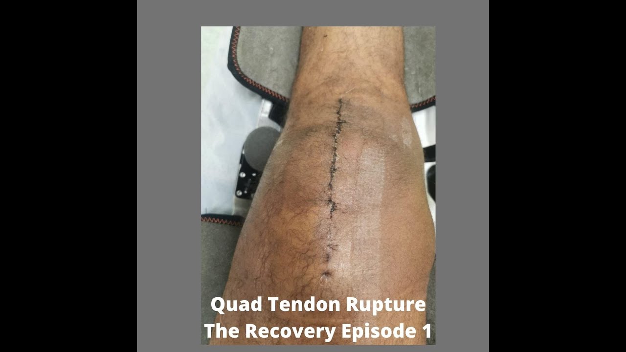 Quad tendon rupture The Recovery: Episode 1