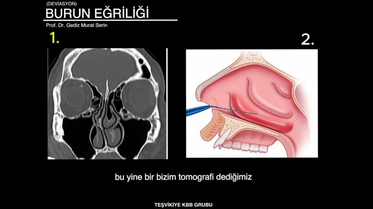 Burun Eğriliği ve Deviasyon | Teşvikiye KBB Grubu