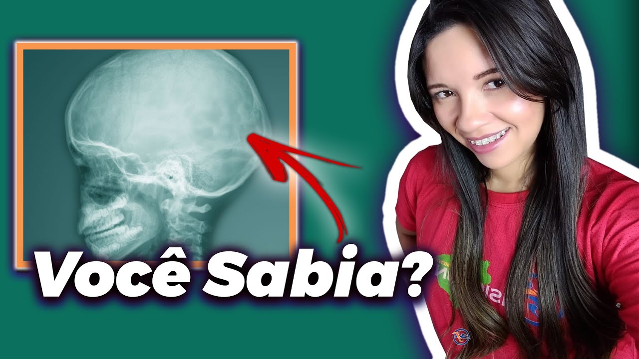 HIDROCEFALIA A VERDADE QUE NÃO CONTARAM - FONOAUDIOLOGIA